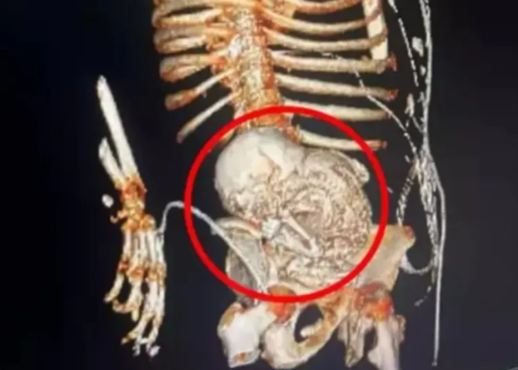 Mujer brasileña fallece tras cirugía para remover feto calcificado de más de 30 años